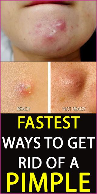 How To Get Rid Of A Pimple Overnight Acne Treatment Overnight How To