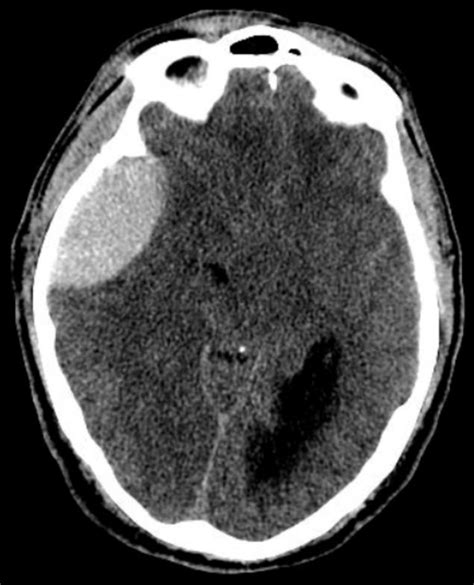 Intracranial Hemorrhage Traumatic Undergraduate Diagnostic Imaging