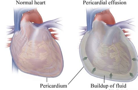 Pericardial Effusion Causes And Treatment Pure Herbal Health