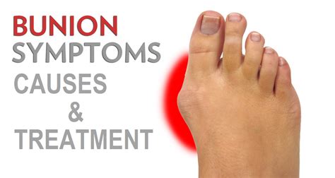 Bunions Causes Symptoms And Treatment