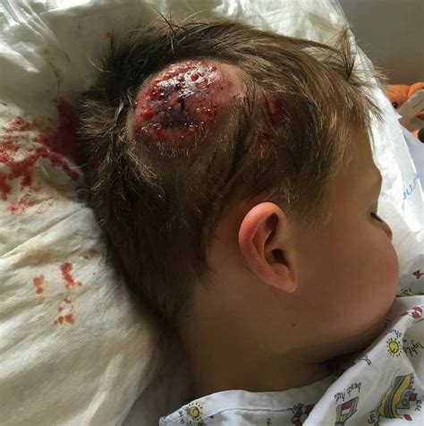 Bullied Schoolboy Who Suffered Horrific Head Injury Finally Home From