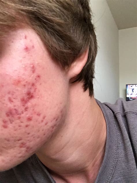 How Severe Is My Acne And What Can Be Done To Help It General Acne Discussion Acne Org Forum