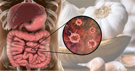 9 herbs to kill parasites in the body natural cleanse