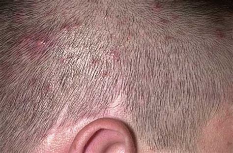 Ringworm On Scalp Symptoms Causes And Treatments