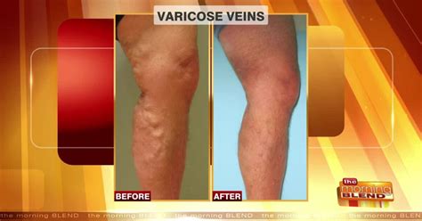 Exploring Vein Issues Symptoms And Solutions