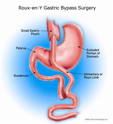 Roux En Y Gastric Bypass North Valley Surgical Associates