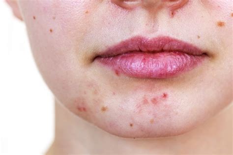 Kenali Ciri Ciri Acne Prone Skin Dan Cara Mengobatinya