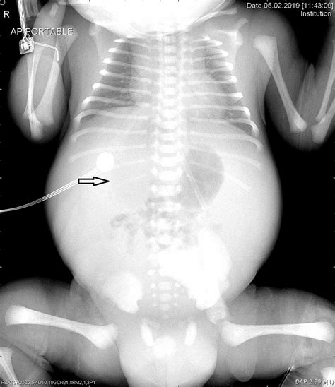 Cureus Isolated Fetal Ascites A Rare Cause