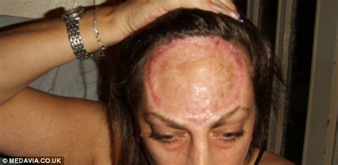 Woman With Rare Cancer Has 85 Of Her Forehead Removed Daily Mail Online