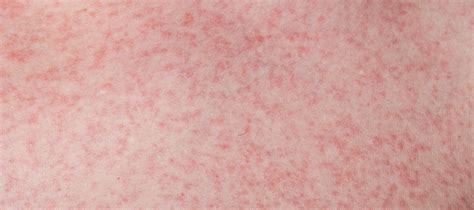 Dengue Rashes Appearance Symptoms And Meaning General Medicine