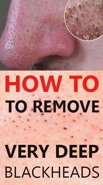 How To Remove These Bad Deep Blackheads From Skin Deep Blackheads