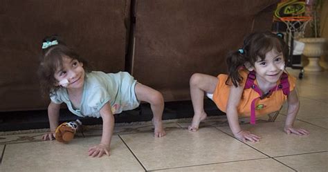 Formerly Conjoined Twins Are Thriving At Home After Risky Surgery To