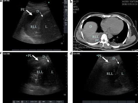 Detection Of Lung Atelectasisconsolidation By Ultrasound In Multiple