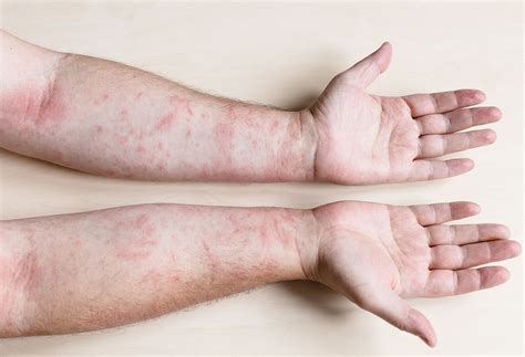 Can Celiac Disease Cause Rashes The Well By Northwell
