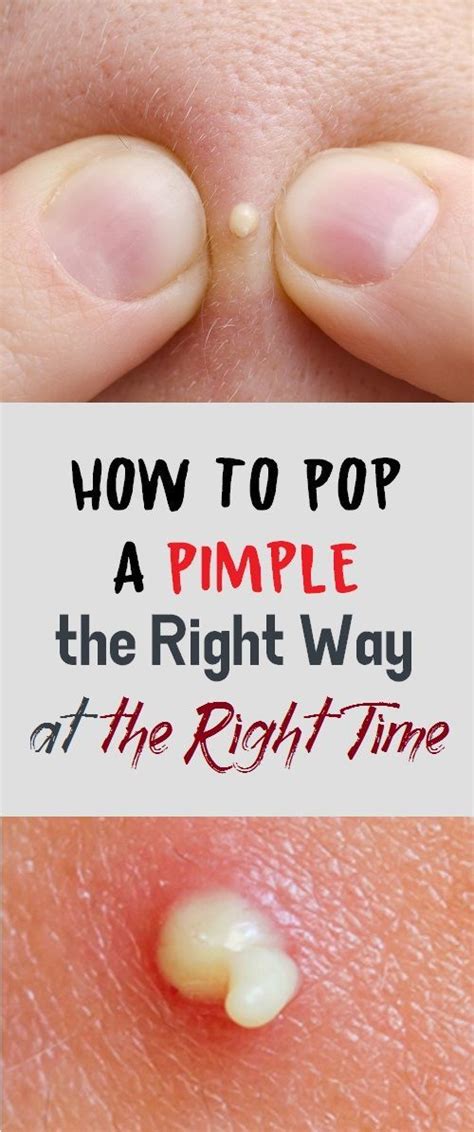 How To Pop A Pimple The Right Way At The Right Time Pimples Pimple