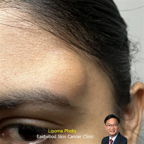 Lipoma Surgery Treatment Removal Sydney Dr Peter Kim Surgery Skin