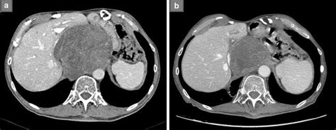 A Ct Scan Documenting A Voluminous Gist Metastasis Compressing The Vena