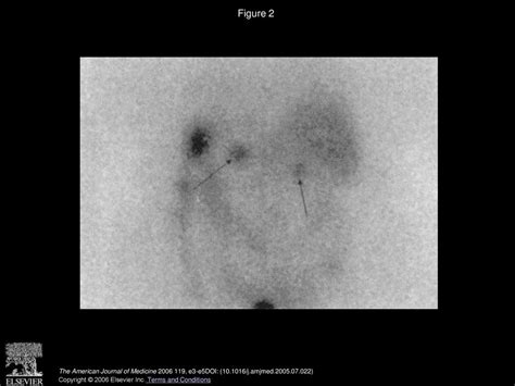 Bilateral Adrenal Adenomas And Persistent Leukocytosis A Unique Case