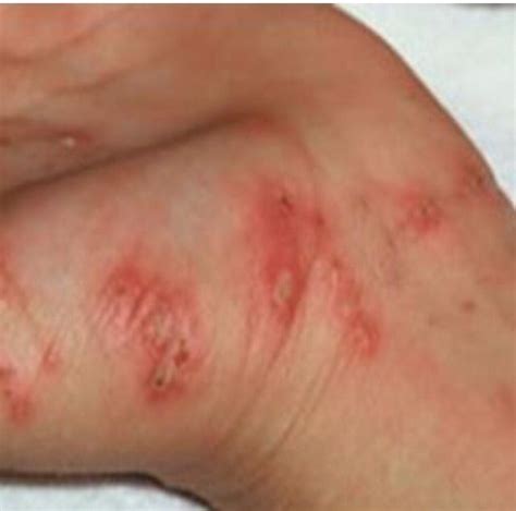 Contagious Diseases Scabies Athletes Foot And Ringworms Are Three