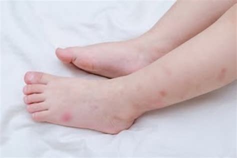 Bed Bug Bites On A Toddlers Feet And Ankles