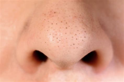 What Are Blackheads And How To Treat Them My Cozy Room
