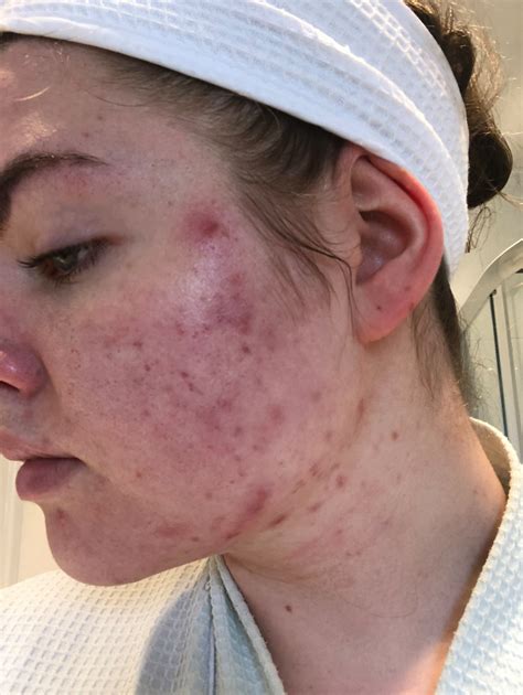 Woman With Severe Acne Tried A £1799 Tanning Water That Cleared Up Her Skin Within A Week