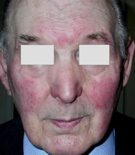 Rosacea Is A Common Rash Usually Occurring On The Face And Which