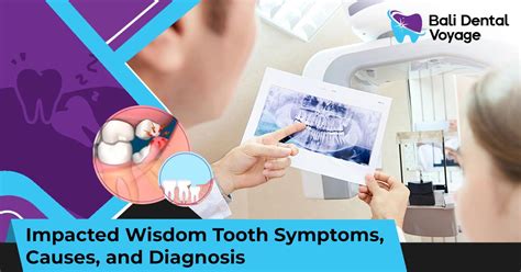Impacted Wisdom Tooth Causes Diagnosis And Symptoms