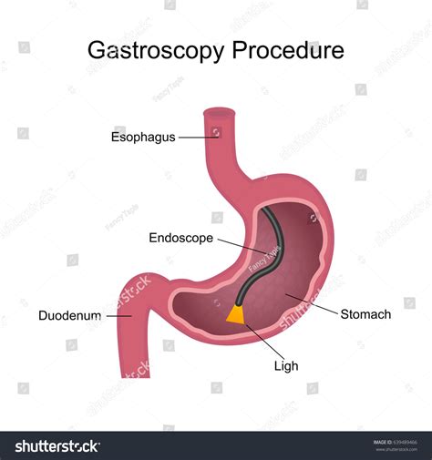 Gastroscopy Procedure Examination Esophagus Stomach Duodenum Stock Illustration