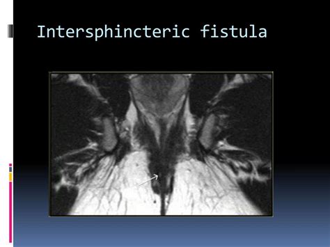 Ppt Mri Imaging Of Perianal Fistula Powerpoint Presentation Free Download Id2986971