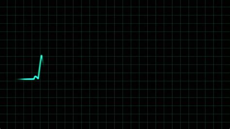 Hd Ecg Ekg Curve A Typical Ecg Tracing Of A Normal Heartbeat Or Cardiac Cycle Consists Of A