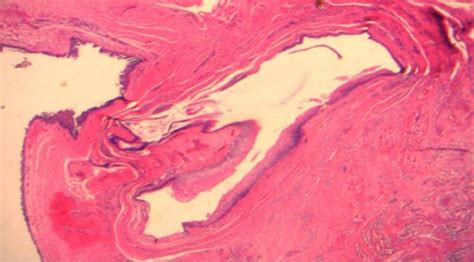 Histopathological Examination Of The Laryngeal Cyst Shows Respiratory