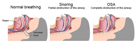 How To Stop Snoring The Only Guide Youll Need Tuck Sleep