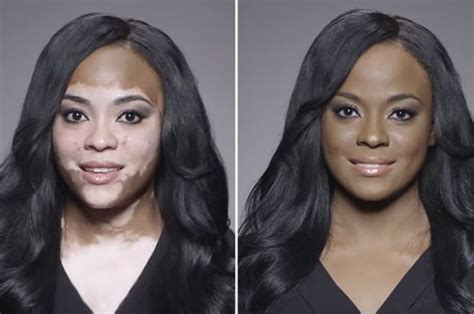 9 Vitiligo Transformations That Prove The Power Of Makeup Vitiligo