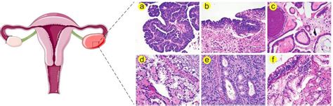 Histological Stratification Of Ovarian Cancer A A High Grade Serous
