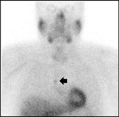 Cureus Ectopic Pleural Parathyroid Adenoma Causing Recurrent Primary