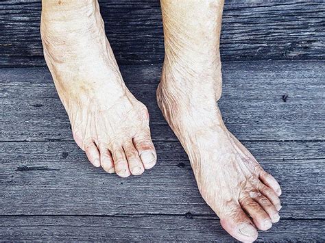 Osteoarthritis In The Foot Symptoms And How To Manage It