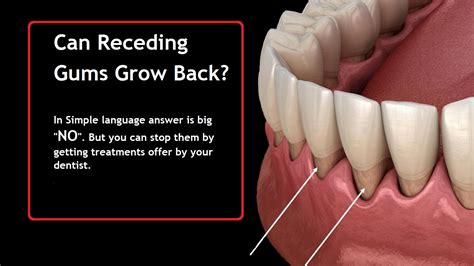 Can Receding Gums Grow Back Guide From Dentist Diary