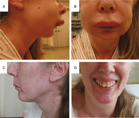 Photographs Of A Patient With Hereditary Angioedema Case 1 Facial