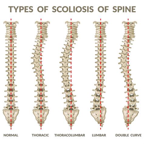 Understanding Scoliosis Houston Spine And Rehabilitation