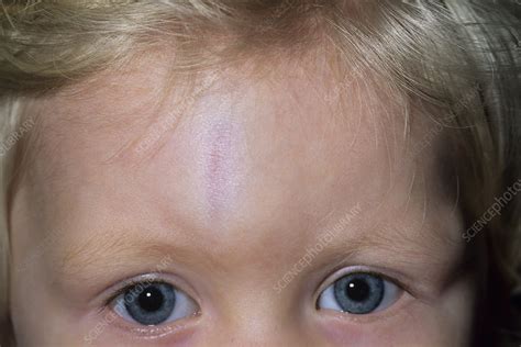 Bump On A Childs Head Stock Image M3301160 Science