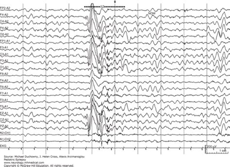 Benign Myoclonic Epilepsy In Infancy Neupsy Key