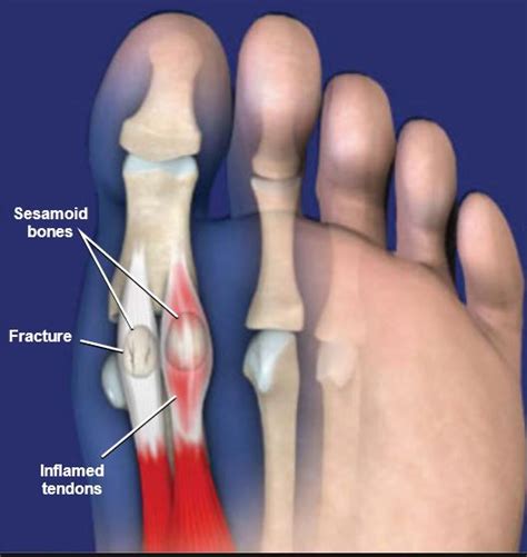 Painful Sesamoiditis