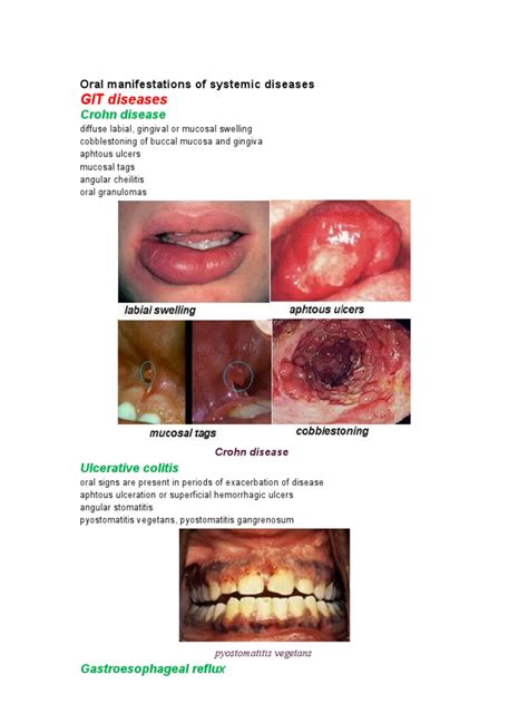 Oral Manifestations Of Systemic Diseases Crohns Disease Cutaneous