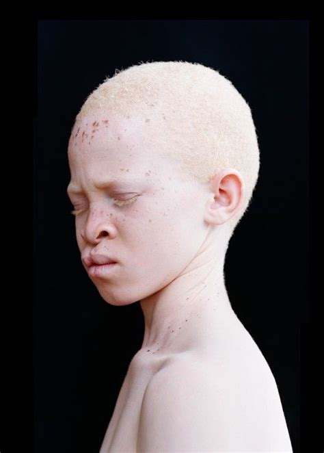 182 Best Beautiful Black Albinos Images On Pinterest Albinism Albino