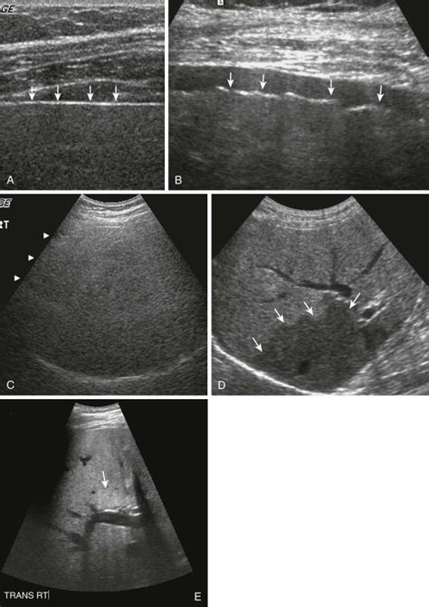 Diffuse Liver Disease Radiology Key