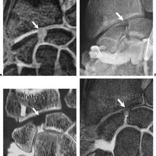 Normal Appearance Of Scapholunate And Lunotriquetral Ligaments On A Download Scientific