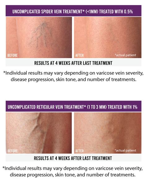 Spider Vein Removal With Asclera® Fall General Surgery Llc