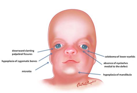 My Notes For Usmle Treacher Collins Digeorge Syndromes St And