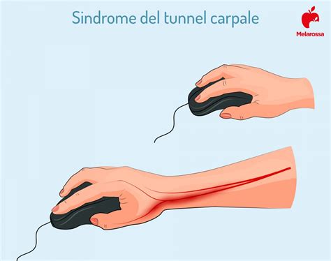 Sindrome Del Tunnel Carpale Sintomi Rimedi Ed Esercizi
